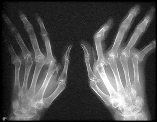 X -Ray Slika ruku pogođenih artrozom