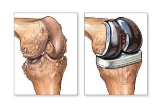 nadomjestak koljena za artrozu