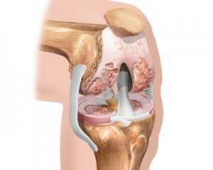 početna faza artroze koljena