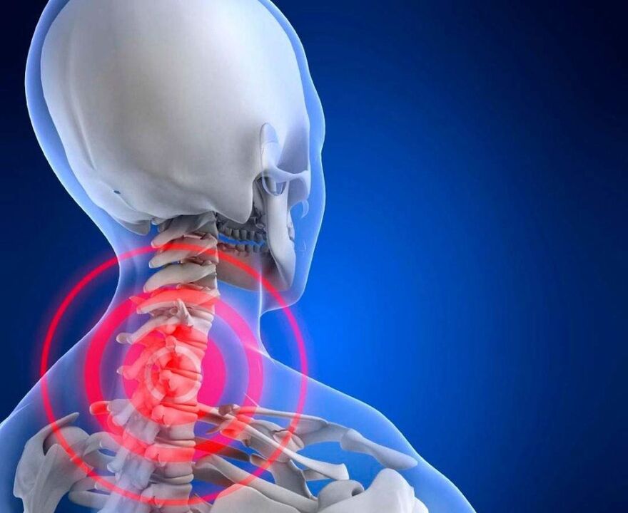 Bol u vratu s cervikalnom osteohondrozom