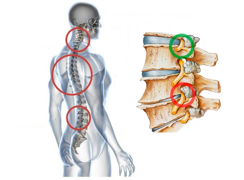 Kako izgleda cervikalna osteohondroza kralježaka