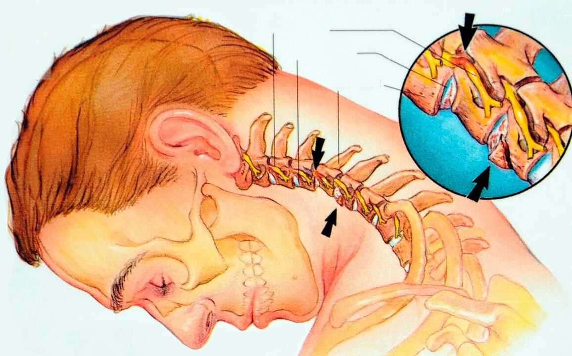 Što je osteohondroza grlića maternice