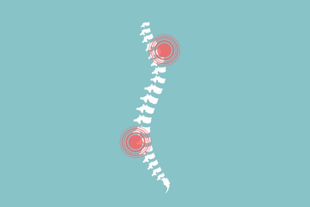 ljudska kralježnica i bolovi u leđima