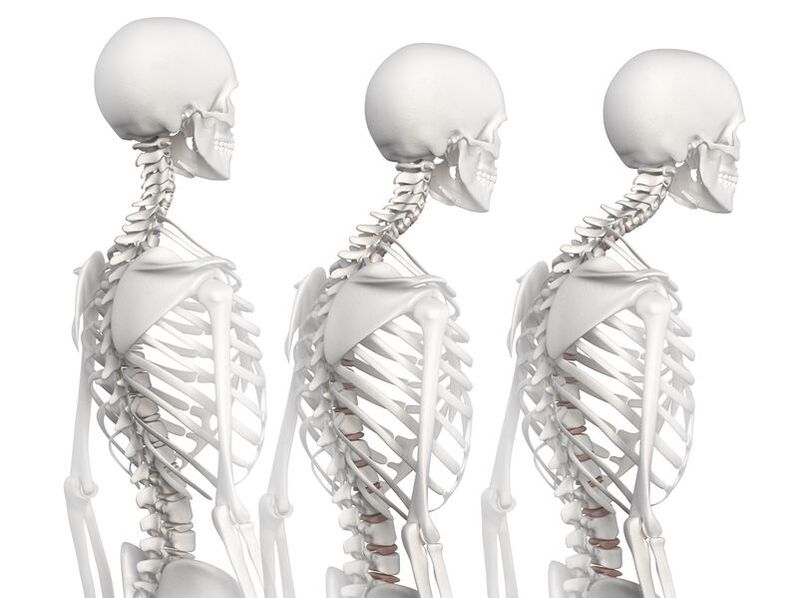 Stupnjevi razvoja torakalne osteohondroze na primjeru skeletnog modela