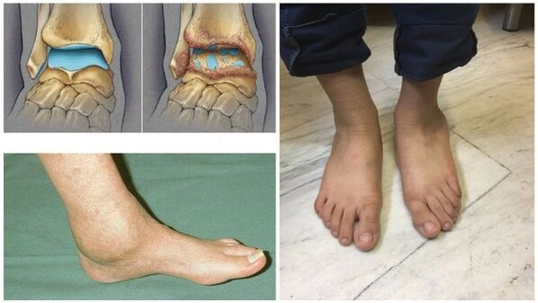 Oticanje i deformacija skočnog zgloba zbog artroze