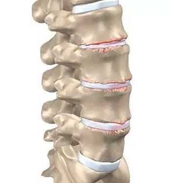 Osteohondroza